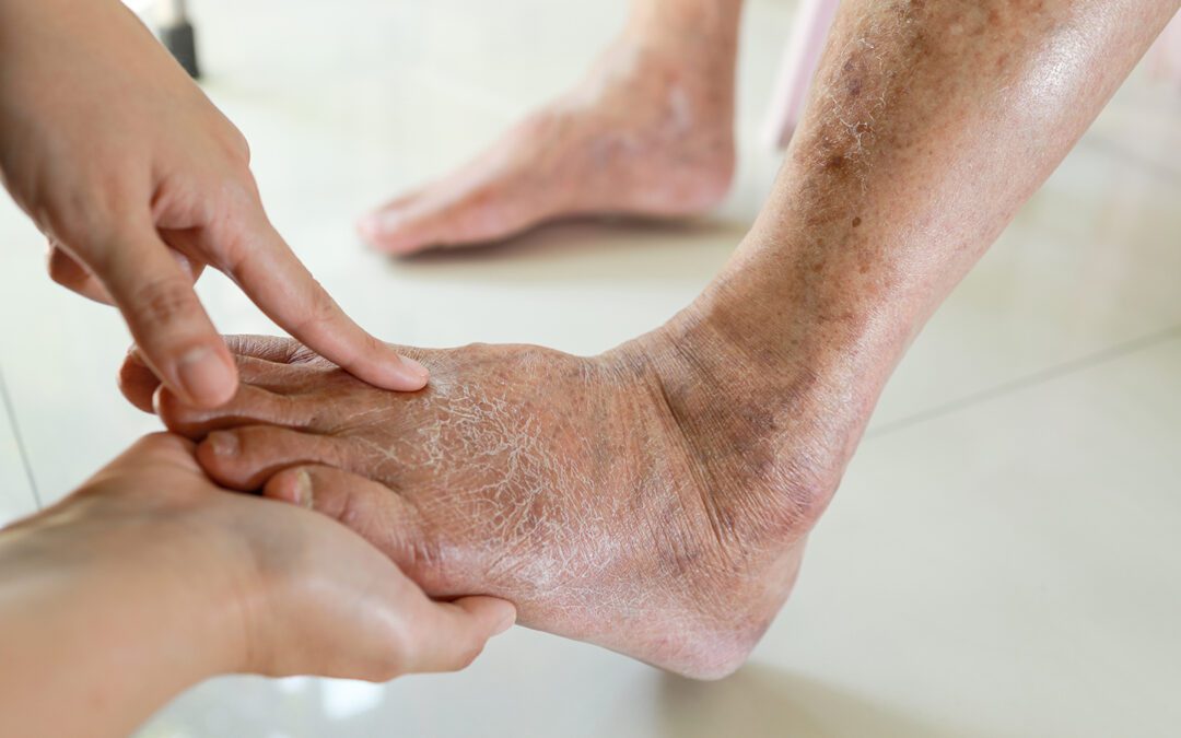 Diabetic Neuropathy: Why Early Detection Matters