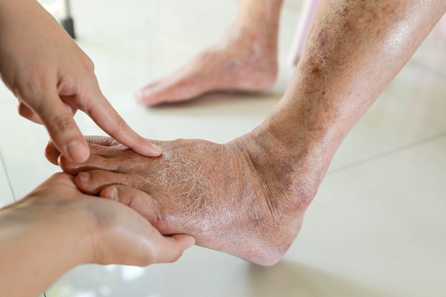 What is Diabetic Neuropathy